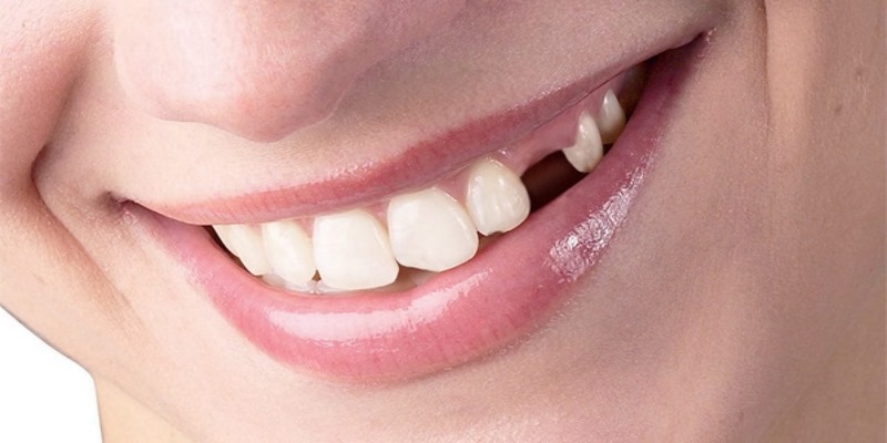 Mơ Thấy Răng Rụng: Giải Đáp Ý Nghĩa & Mách Bạn Con Số Chuẩn 1 Ý nghĩa của giấc mơ thấy răng rụng là tốt hay xấu?